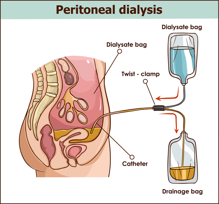 Peritoneal-Dialysis